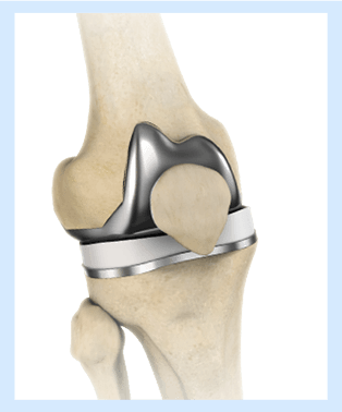 Unicompartment Knee Replacement