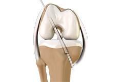 ACL Reconstruction