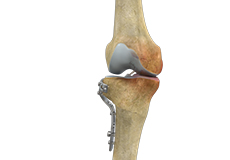 High Tibial Osteotomy