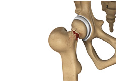 Hip Injury