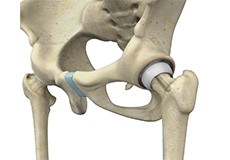 Failed Meniscus Repair