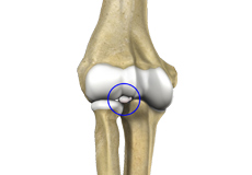 Loose Bodies in the Knee