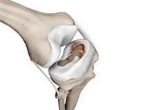 Meniscal Injuries