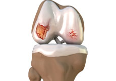 Osteoarthritis