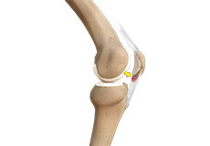 Patellar Tendinitis