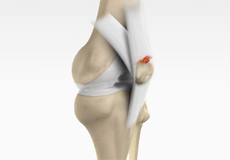 Quadriceps Tendon Rupture