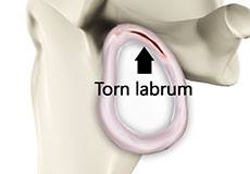 Shoulder Labral Tear