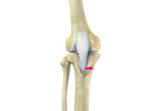 Tibial Tubercle Osteotomy