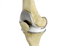 What is New in Knee Replacement