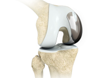 Unicondylar knee Replacement